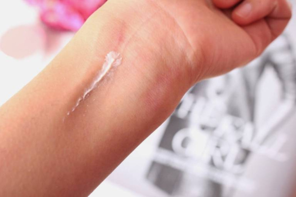 15 Cách Trị Nám Gò Má An Toàn Từ Thiên Nhiên