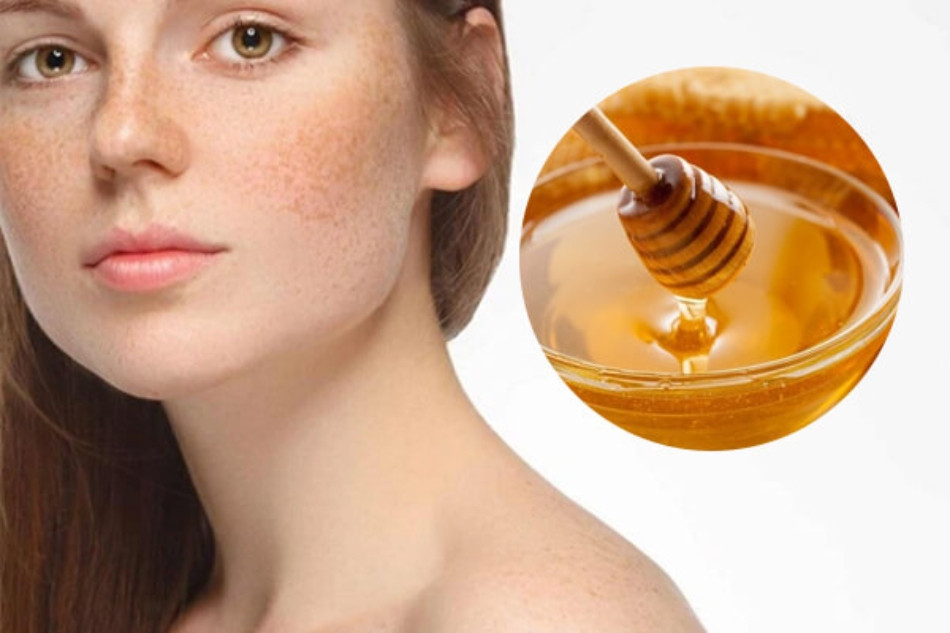 15 Cách Trị Nám Gò Má An Toàn Từ Thiên Nhiên