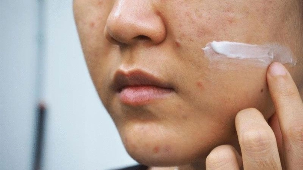 7 bước chăm sóc da sau khi trị sẹo rỗ chi tiết chuẩn y khoa