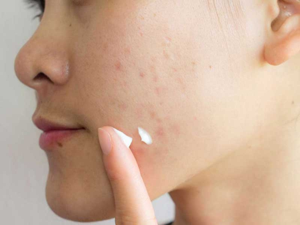 7 bước chăm sóc da sau khi trị sẹo rỗ chi tiết chuẩn y khoa