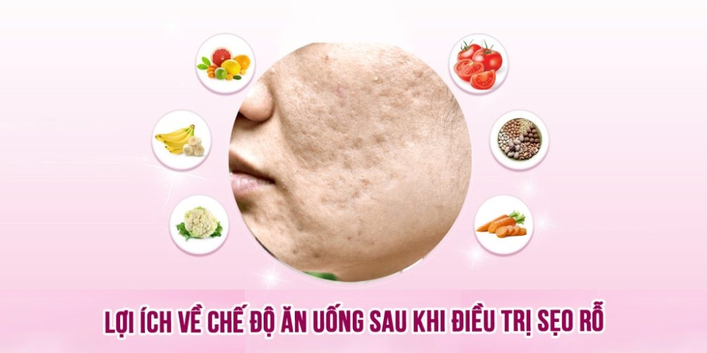 7 bước chăm sóc da sau khi trị sẹo rỗ chi tiết chuẩn y khoa