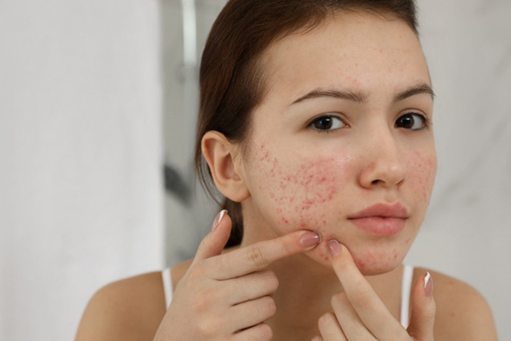 7 bước dưỡng da ban đêm cho da mụn hiệu quả nhất