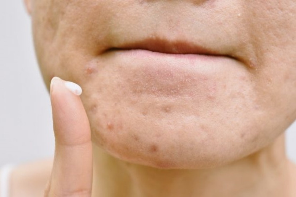 7 bước dưỡng da ban đêm cho da mụn hiệu quả nhất