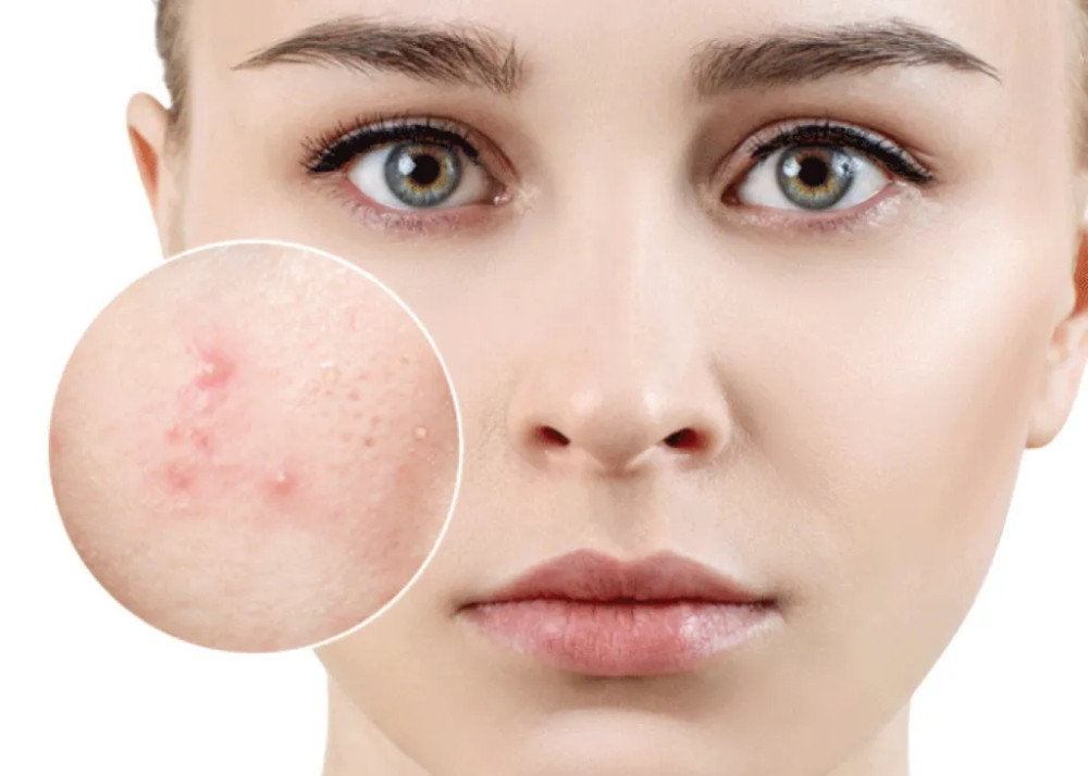 7 bước dưỡng da ban đêm cho da mụn hiệu quả nhất