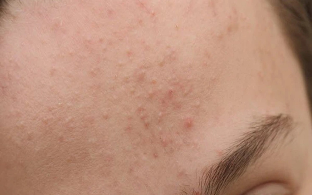 7 bước trong quy trình chăm sóc da mụn nhanh chóng và những lưu ý