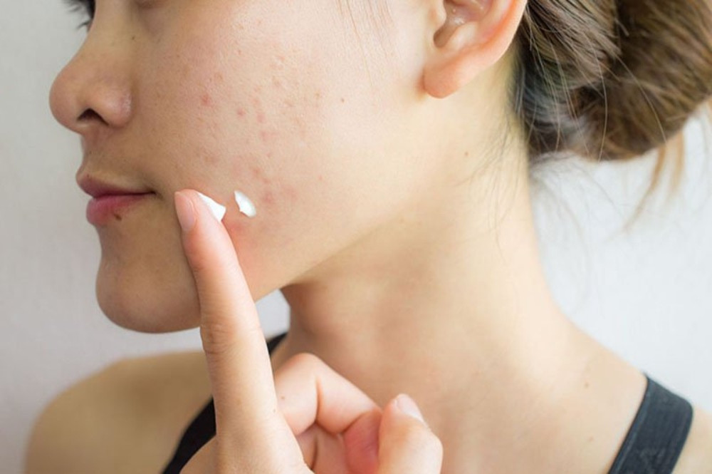 7 bước trong quy trình chăm sóc da mụn nhanh chóng và những lưu ý