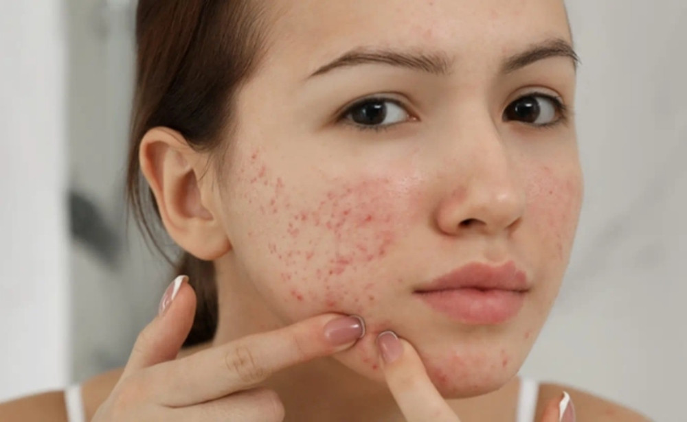 7 bước trong quy trình chăm sóc da mụn nhanh chóng và những lưu ý