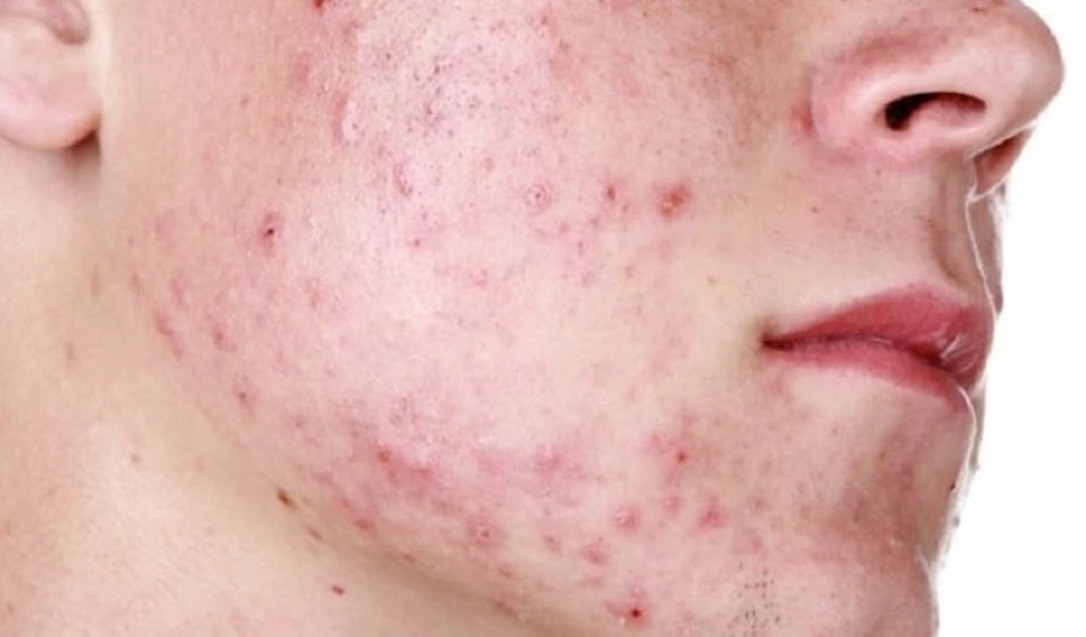 7 bước trong quy trình chăm sóc da mụn nhanh chóng và những lưu ý