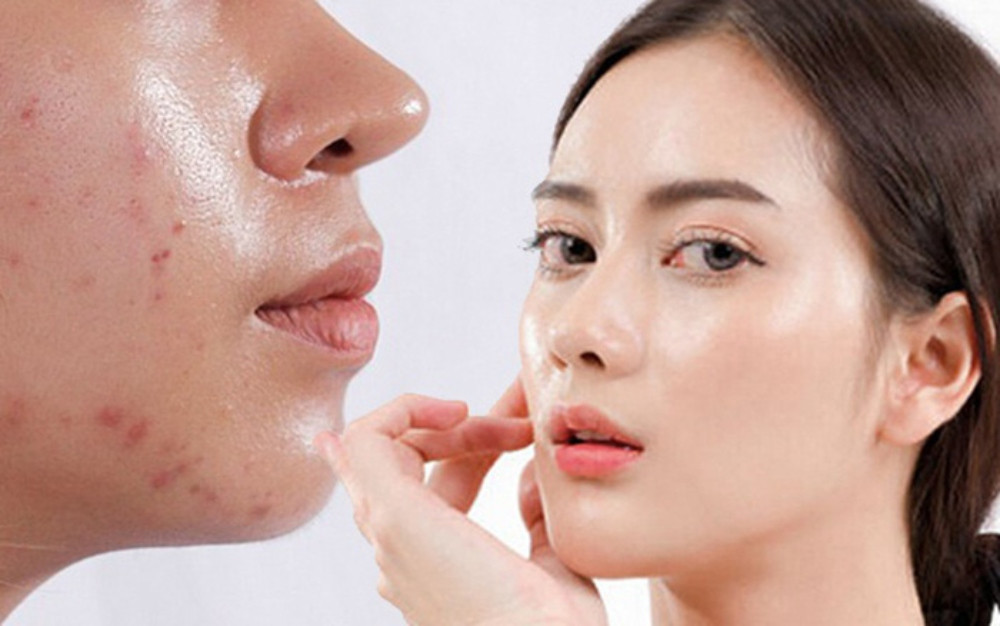 8 bước chăm sóc da dầu lỗ chân lông to khoa học, hiệu quả tại nhà