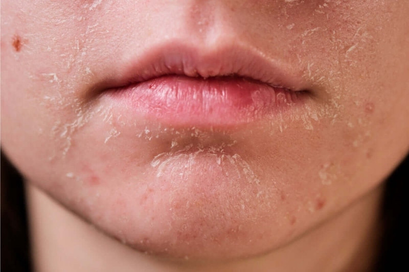 8 bước chăm sóc da khô hiệu quả