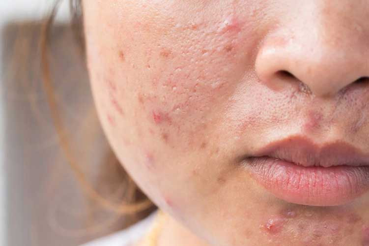 BHA Là Gì? Tìm Hiểu Về Salicylic Acid Trong Chăm Sóc Da