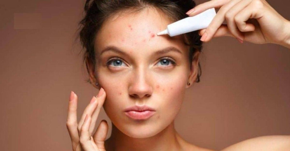Bí quyết chăm sóc da hỗn hợp thiên dầu bị mụn hiệu quả