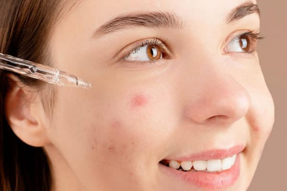Bí quyết chăm sóc da hỗn hợp thiên dầu bị mụn hiệu quả