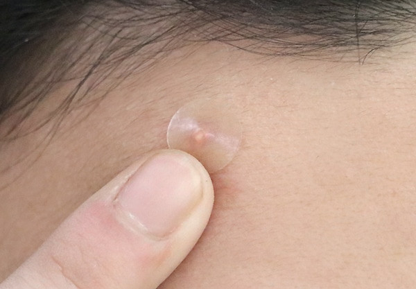 Các Phương Pháp Trị Mụn An Toàn và Hiệu Quả