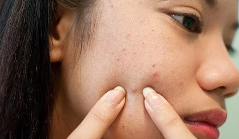 Cách Chăm Sóc Da Dầu Mụn Hiệu Quả: 8 Bước Đơn Giản Giúp Phục Hồi Nhanh Chóng