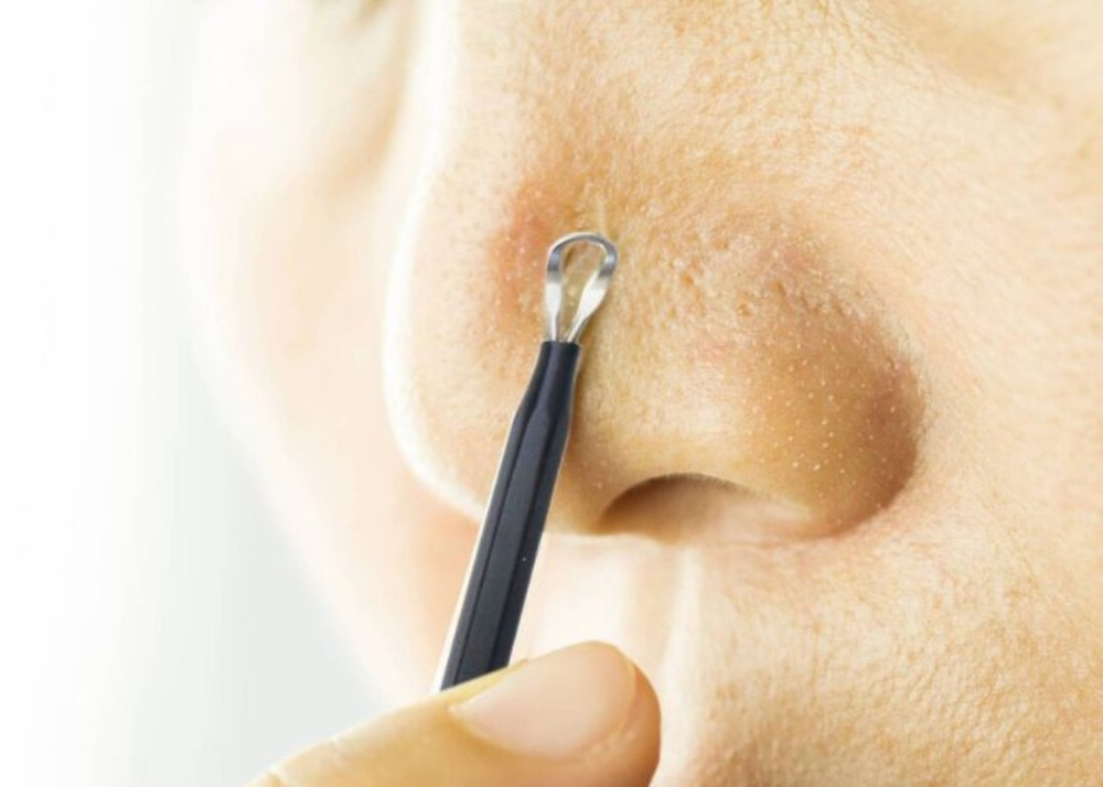 Cách Chăm Sóc Da Mụn Đầu Đen Hiệu Quả và Đơn Giản