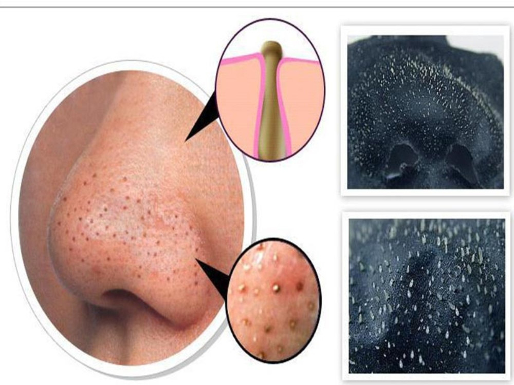 Cách Chăm Sóc Da Mụn Đầu Đen Hiệu Quả và Đơn Giản