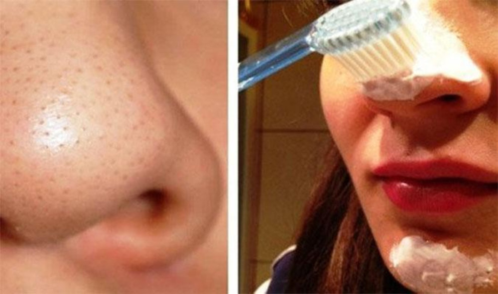 Cách Chăm Sóc Da Mụn Đầu Đen Hiệu Quả và Đơn Giản