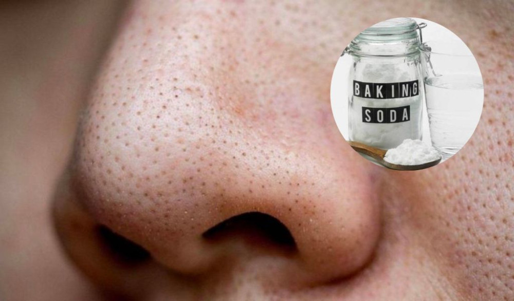 Cách Chăm Sóc Da Mụn Đầu Đen Hiệu Quả và Đơn Giản