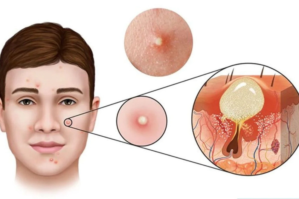 Cách Chăm Sóc Da Mụn Viêm Hiệu Quả Và An Toàn