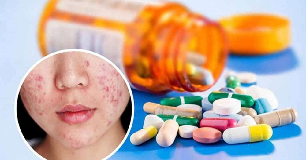 Cách Chăm Sóc Da Mụn Viêm Hiệu Quả Và An Toàn