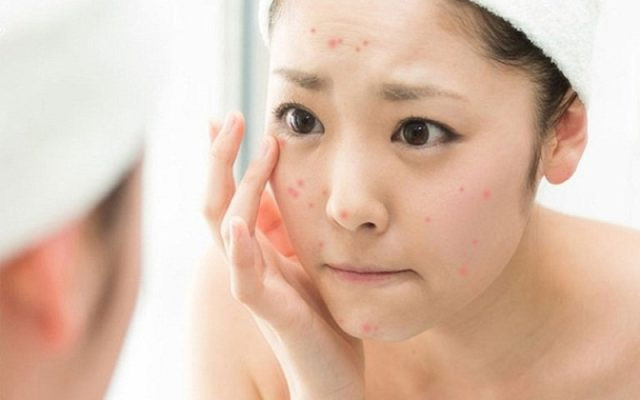 Cách chăm sóc da sau mụn giúp da phục hồi và ngăn ngừa tái phát
