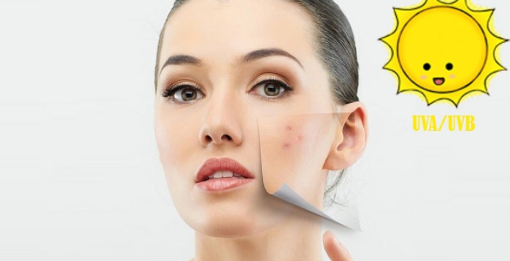 Cách chăm sóc da sau mụn giúp da phục hồi và ngăn ngừa tái phát