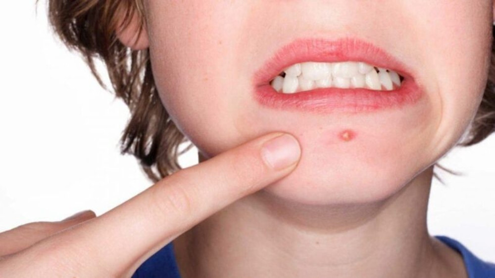 Cách Chăm Sóc Mụn Bọc Đúng Cách Để Tránh Tình Trạng Tái Phát