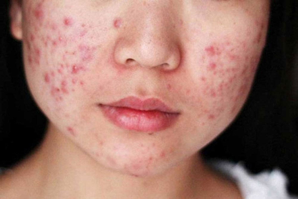Cách Chăm Sóc Mụn Bọc Đúng Cách Để Tránh Tình Trạng Tái Phát