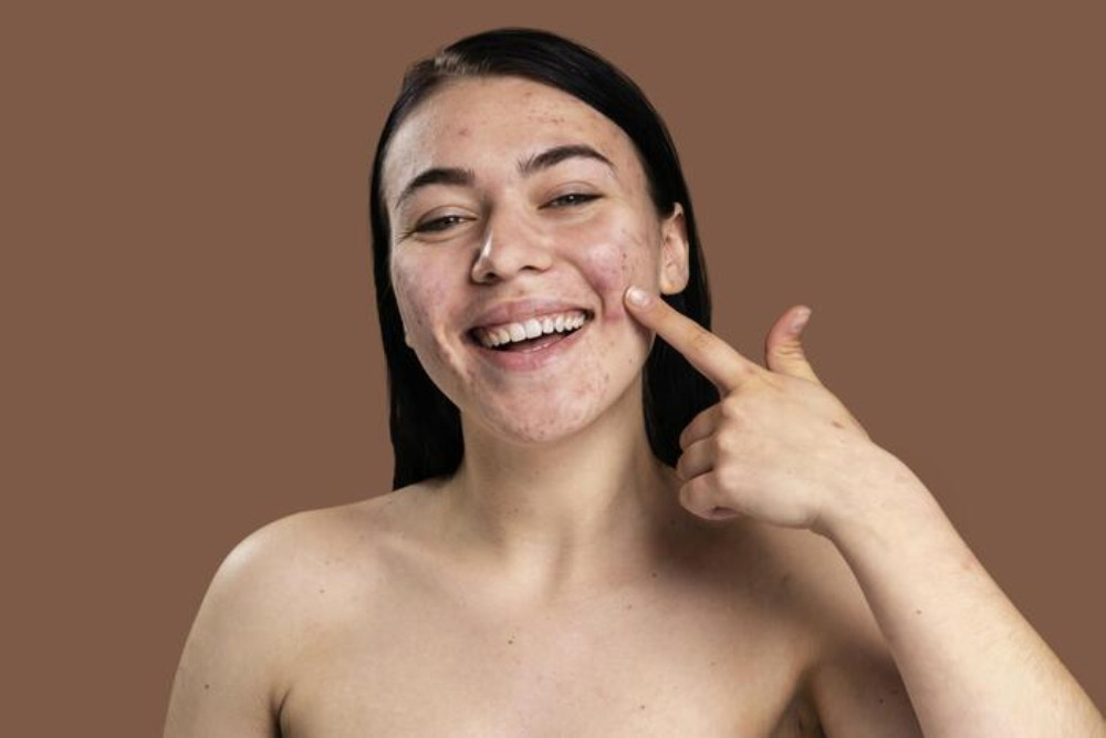 Cách Chăm Sóc Mụn Bọc Đúng Cách Để Tránh Tình Trạng Tái Phát