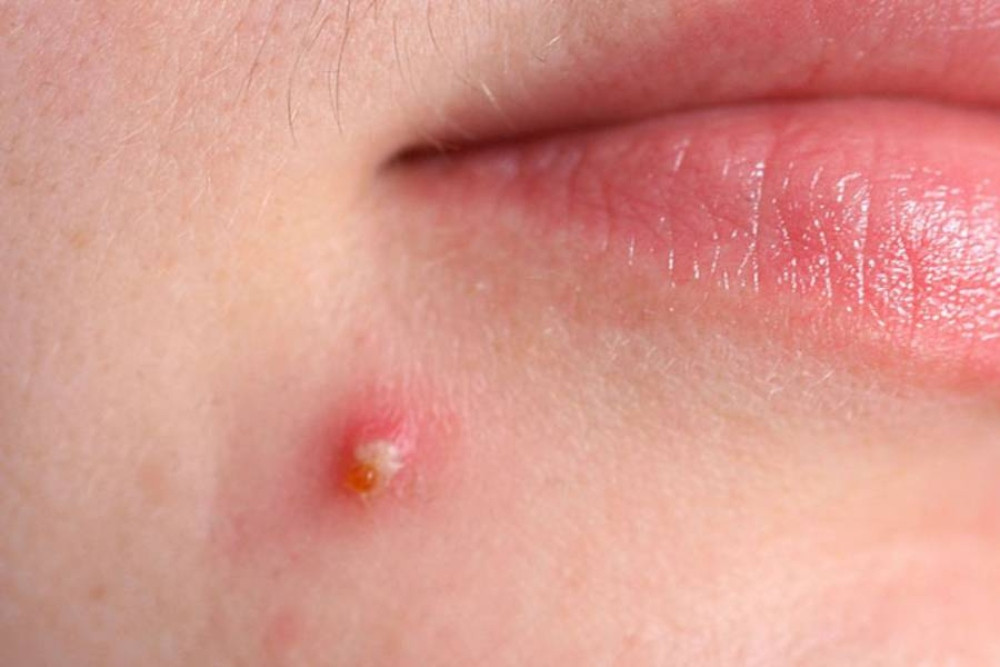 Cách Chăm Sóc Mụn Bọc Đúng Cách Để Tránh Tình Trạng Tái Phát