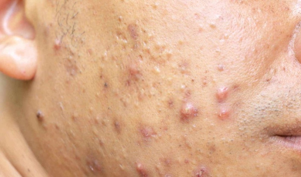 Cách Chăm Sóc Mụn Bọc Đúng Cách Để Tránh Tình Trạng Tái Phát