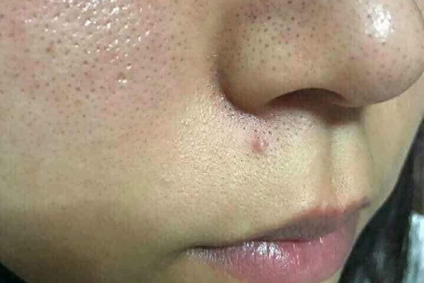 Đặc Điểm và Cách Chăm Sóc Cho Da Dầu Hiệu Quả