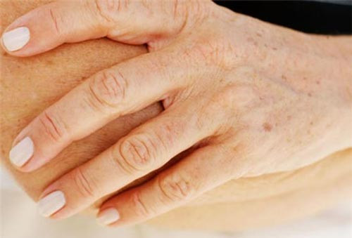 Đồi mồi là gì? 3 Cách chăm sóc da đồi mồi hiệu quả