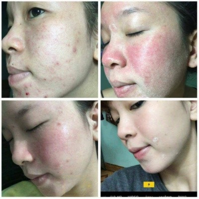 Dùng thuốc rượu trị mụn có tốt không? Da bị nhiễm thuốc rượu