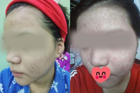 Dùng thuốc rượu trị mụn có tốt không? Da bị nhiễm thuốc rượu