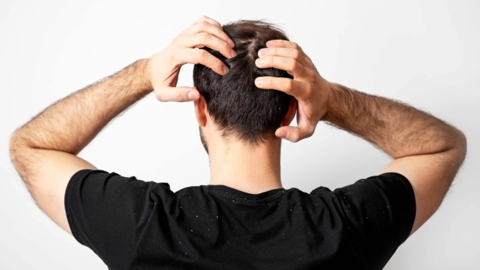 Gàu &#8211; Nguyên Nhân Gây Ra Và Cách Điều Trị Hiệu Quả