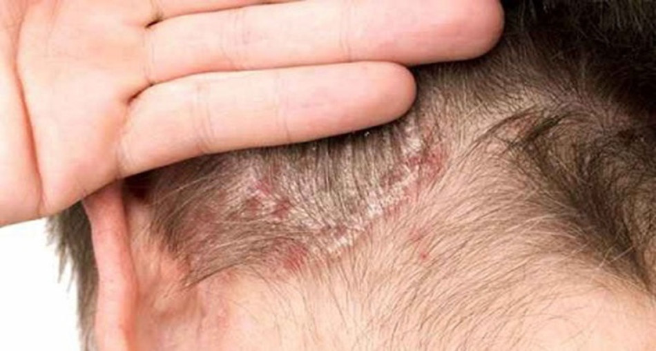 Gàu &#8211; Nguyên Nhân Gây Ra Và Cách Điều Trị Hiệu Quả