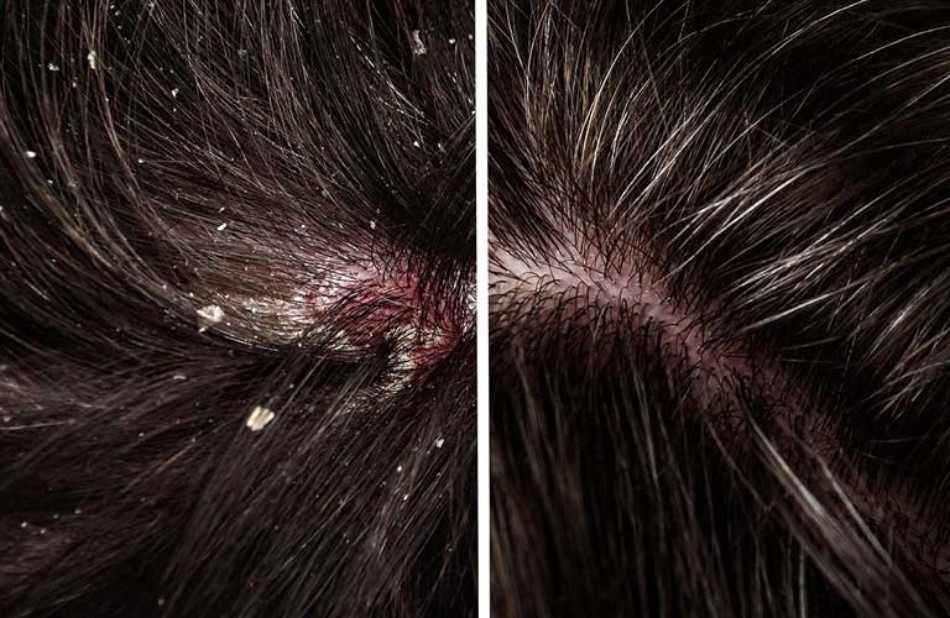 Gàu &#8211; Nguyên Nhân Gây Ra Và Cách Điều Trị Hiệu Quả
