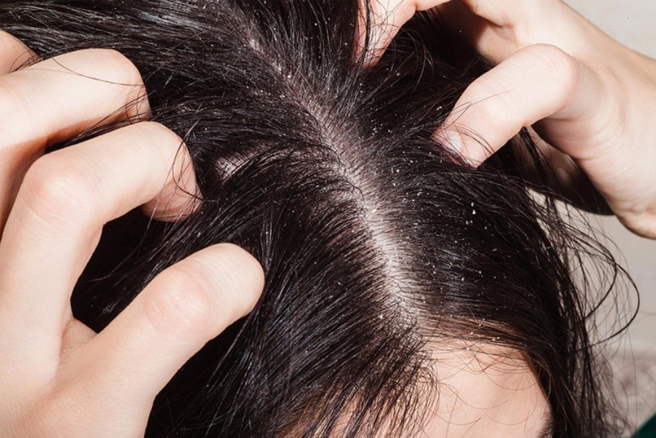 Gàu &#8211; Nguyên Nhân Gây Ra Và Cách Điều Trị Hiệu Quả