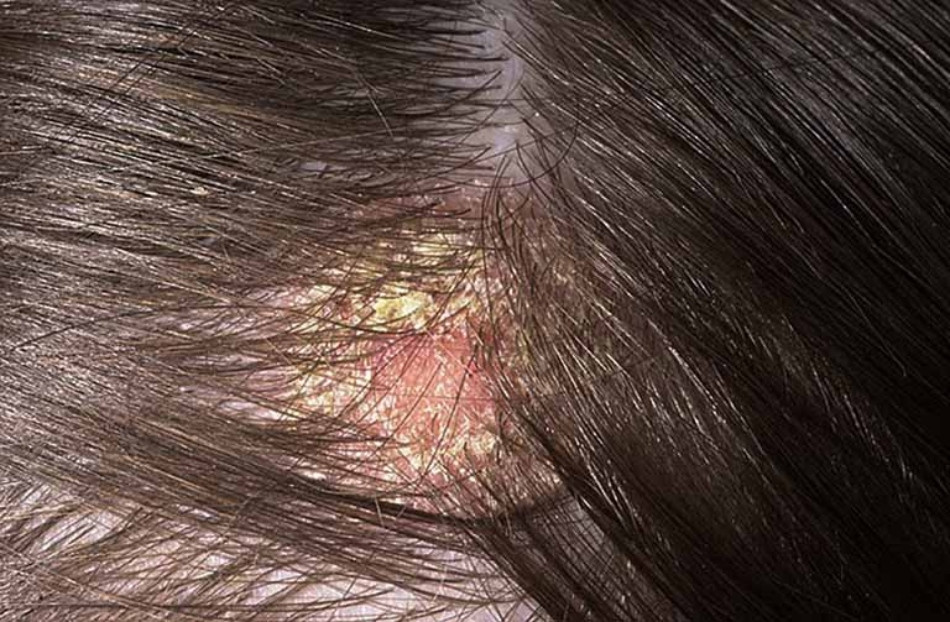 Gàu &#8211; Nguyên Nhân Gây Ra Và Cách Điều Trị Hiệu Quả