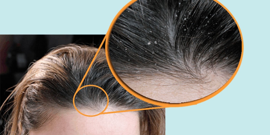 Gàu &#8211; Nguyên Nhân Gây Ra Và Cách Điều Trị Hiệu Quả