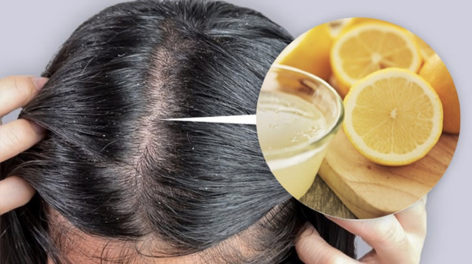 Gàu ống có lây không? 9 nguyên nhân thực sự gây ra gàu ống