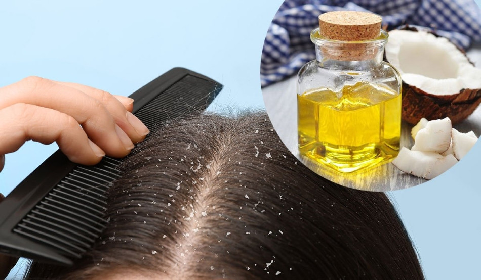 Gàu ống có lây không? 9 nguyên nhân thực sự gây ra gàu ống