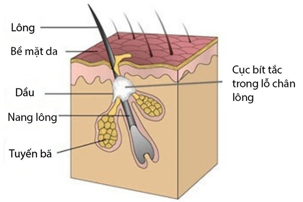 Hiểu Rõ Về Mụn Thịt: Nguyên Nhân và Cách Điều Trị Hiệu Quả