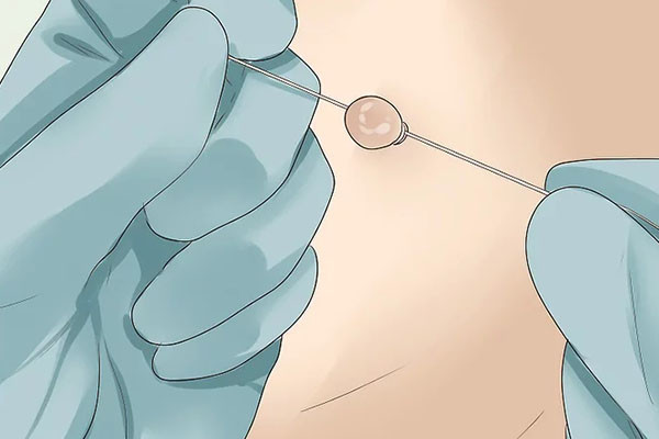 Hiểu Rõ Về Mụn Thịt: Nguyên Nhân và Cách Điều Trị Hiệu Quả