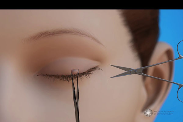 Hiểu Rõ Về Mụn Thịt: Nguyên Nhân và Cách Điều Trị Hiệu Quả