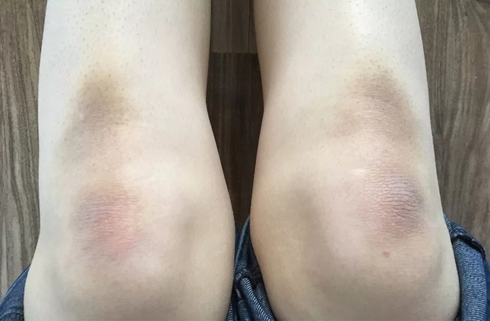 Hướng dẫn 12 cách làm trắng đầu gối, khuỷu tay nhanh chóng, dễ thực hiện