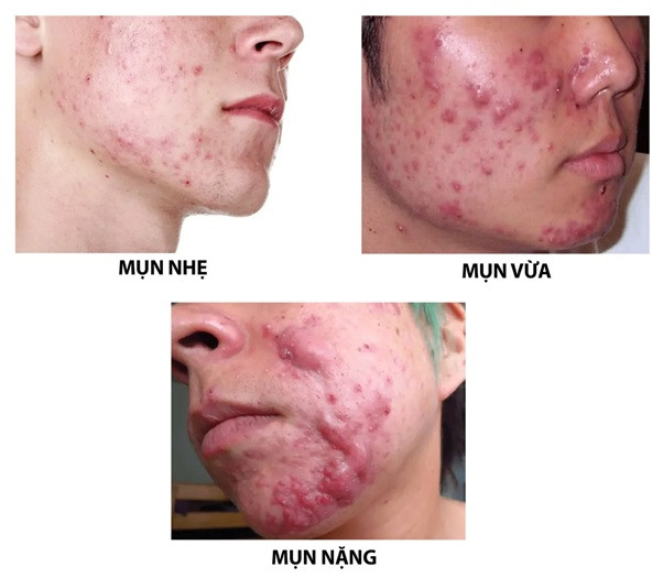 Klenzit C: Những Cảnh Báo Cần Lưu Ý Khi Sử Dụng