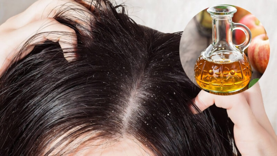 Mẹo 15 cách trị hết gàu TẬN GỐC cực nhanh và đơn giản tại nhà